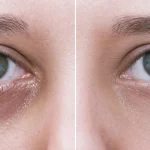 Göz Altı Morlukları Nasıl Geçer?