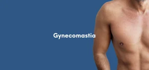Gynecomastia