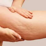 Selülit Nasıl Geçer?