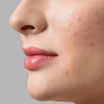 Yüzdeki Sivilce Lekeleri Nasıl Geçer?